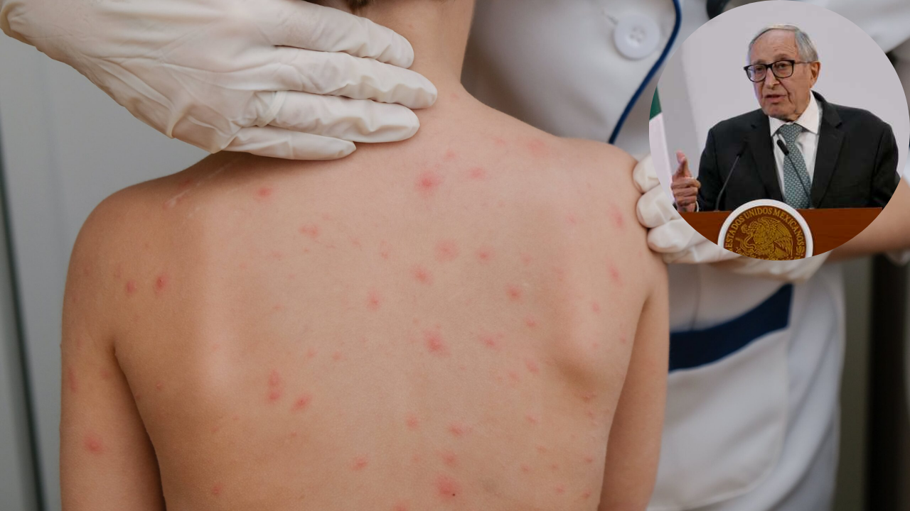 México registra más de 4 mil casos de Sarampión 