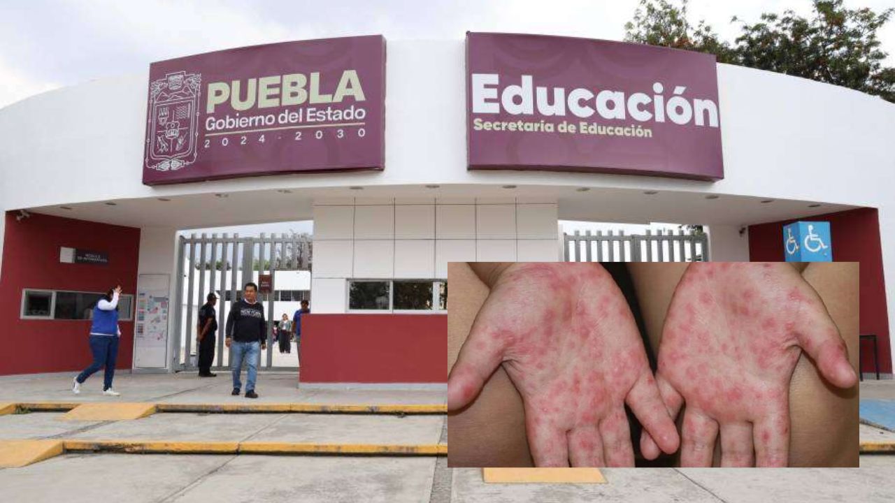 Puebla reporta más de 400 casos de virus Coxsackie