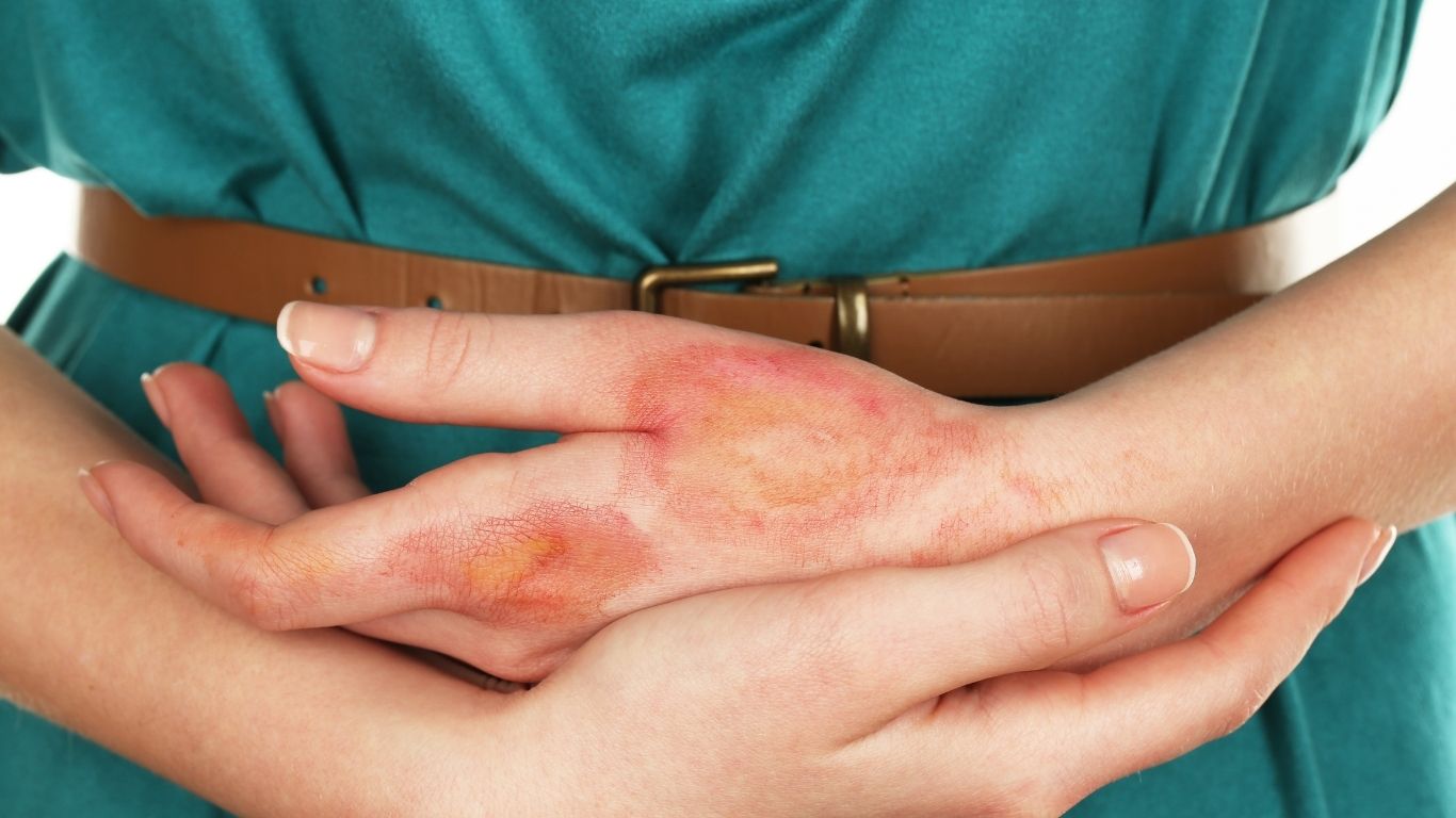 Casos de sífilis aumentan en México