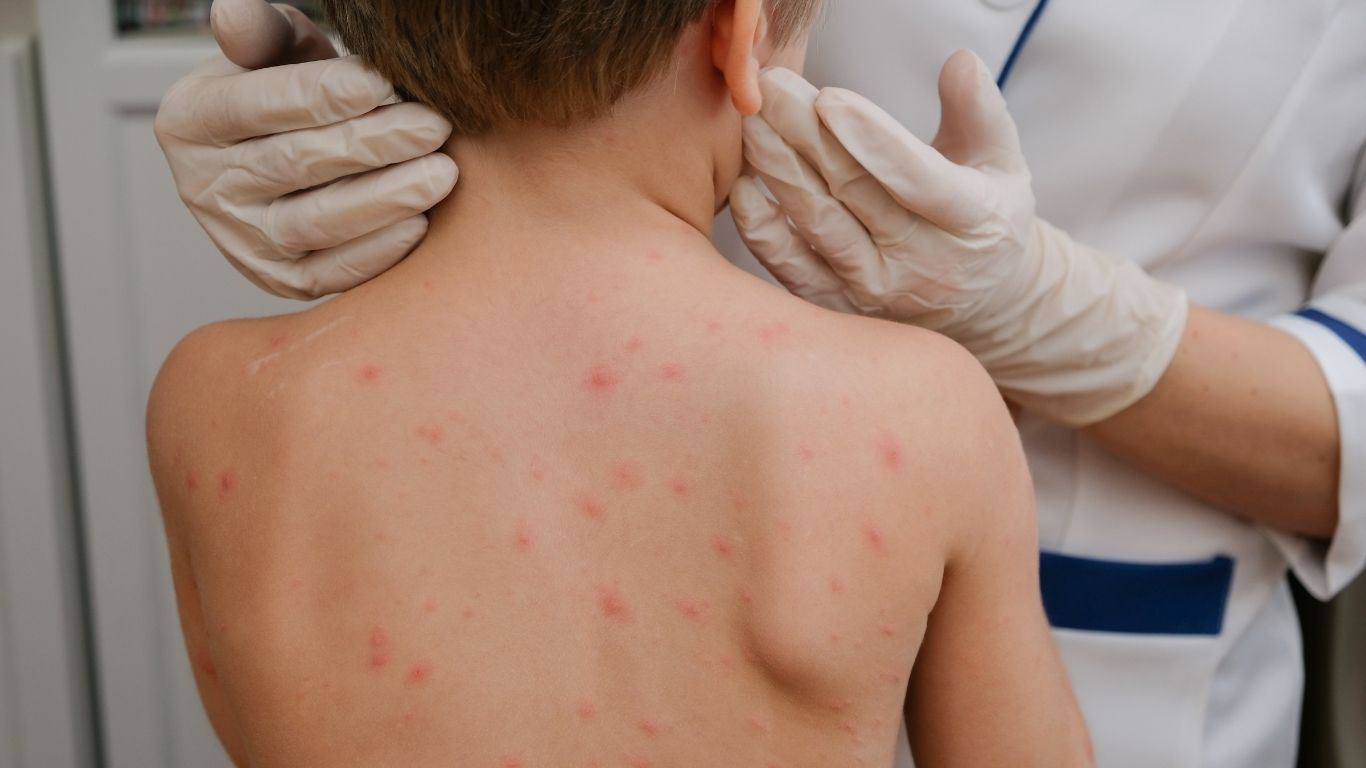 Brote de sarampión en EU