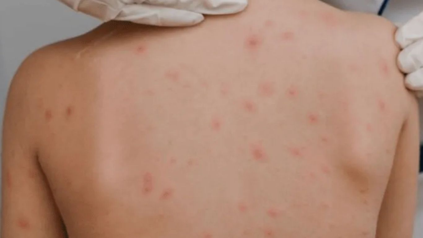 Sarampión cobra su primera víctima en Michoacán