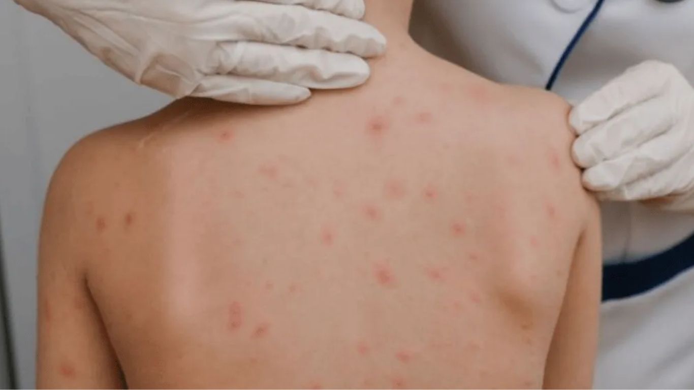 México supera los 6 mil casos de sarampión 