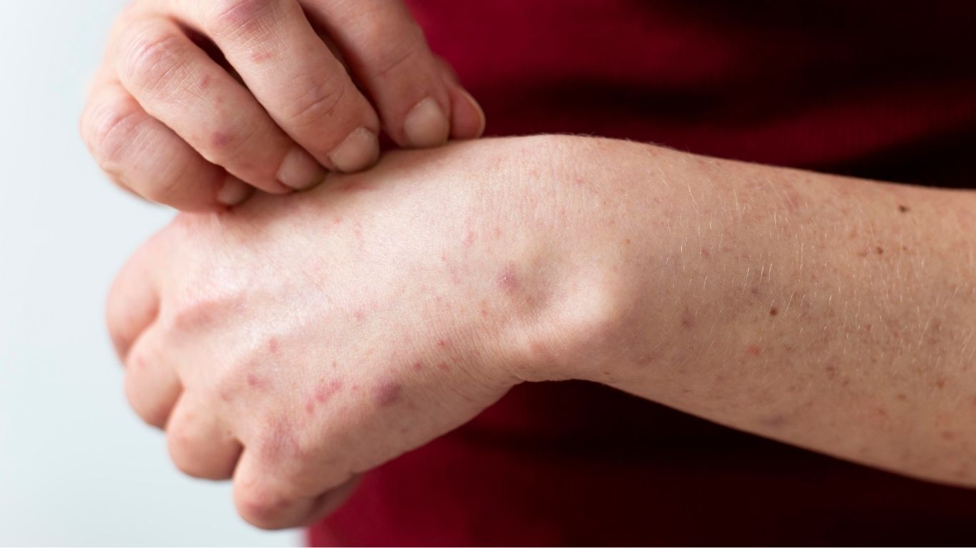 Sarampión obliga a confinar centro migratorio en Texas