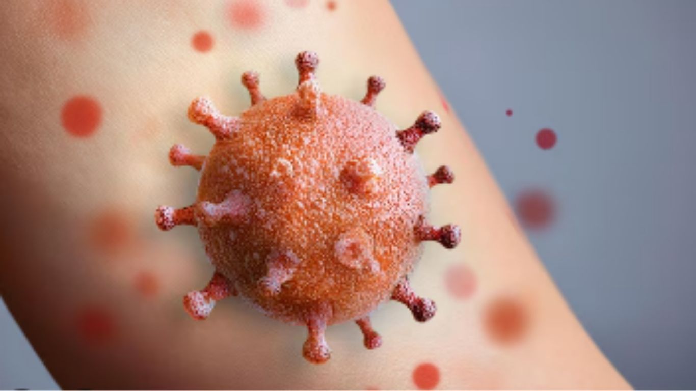 Confirman cuarto caso de sarampión en SLP