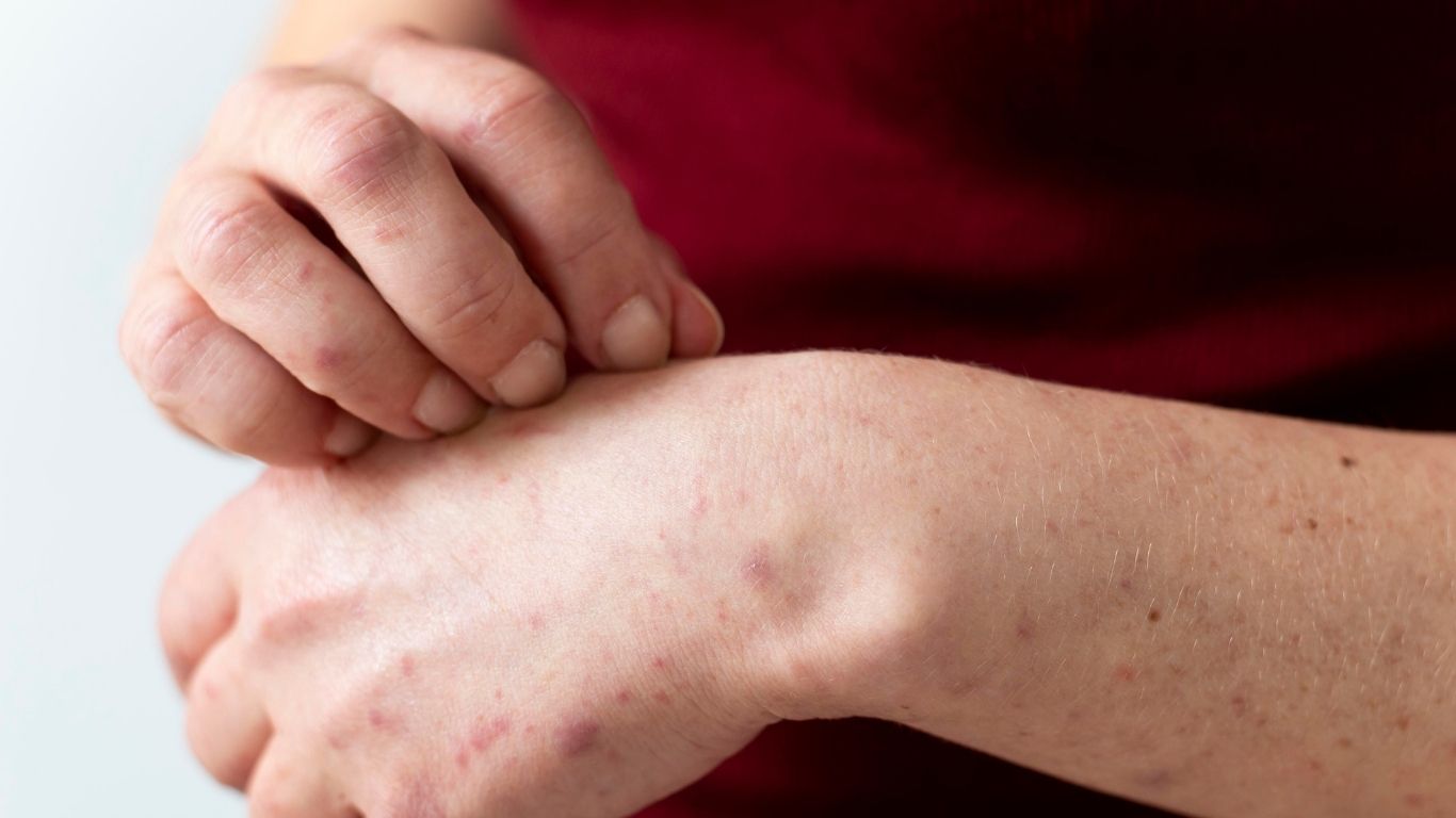 Aumentan casos de sarampión en México