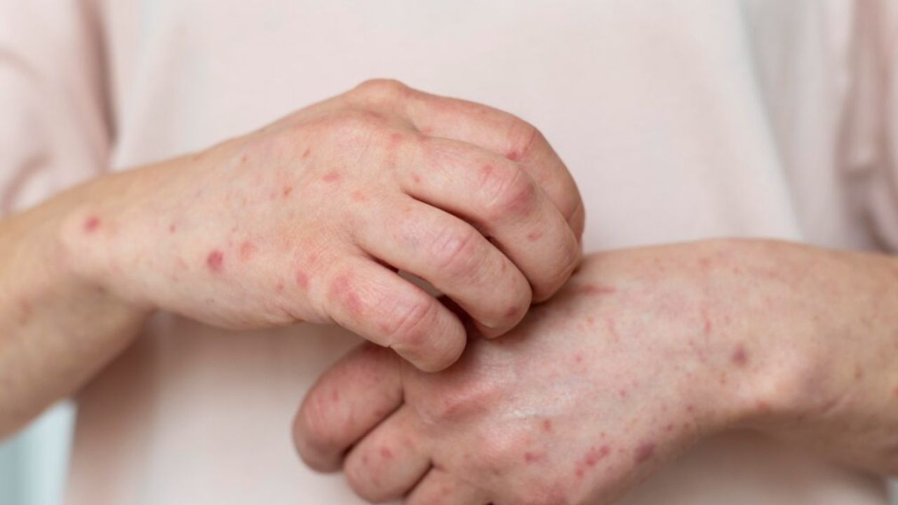 Muertes por sarampión suben a 29 en México