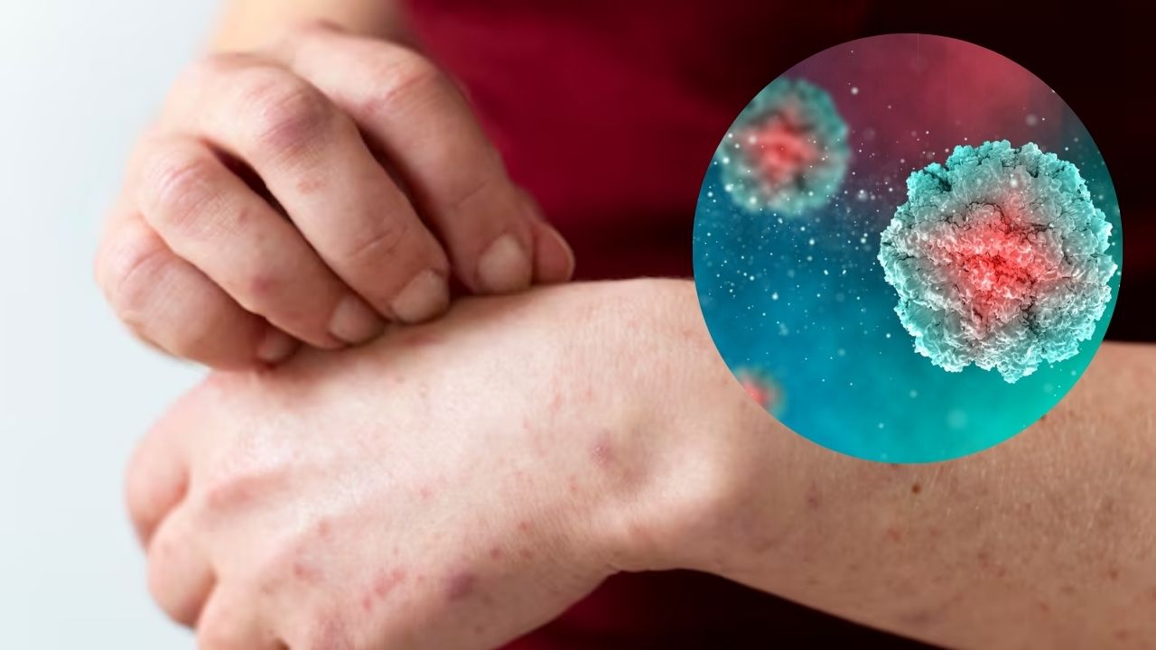 Sarampión se extiende por Estados Unidos