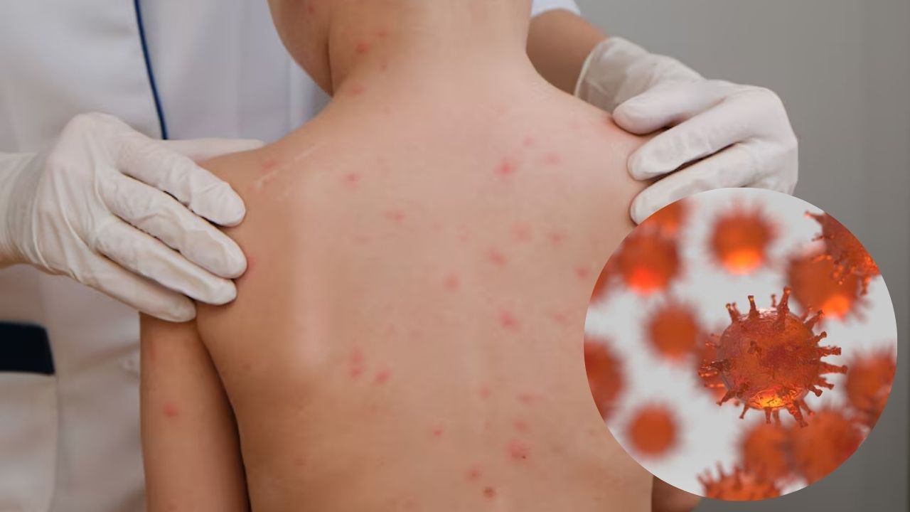 EU enfrenta un preocupante resurgimiento del sarampión