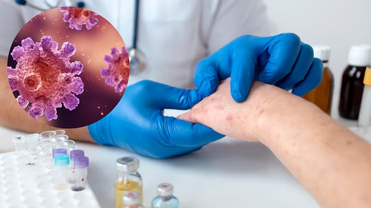 México, tercer país con más casos de sarampión en América Latina