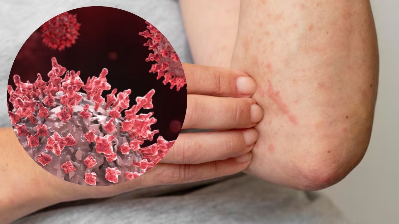 Primer caso de sarampión en Querétaro