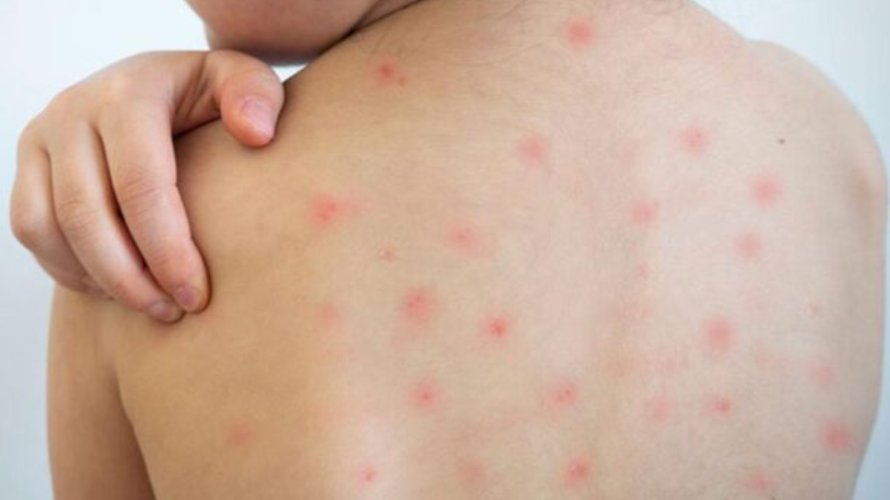 Guerrero confirma primer fallecimiento por sarampión