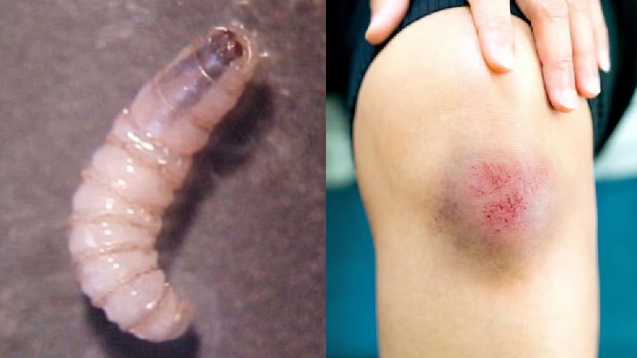 Otro caso miasis humana por gusano barrenador