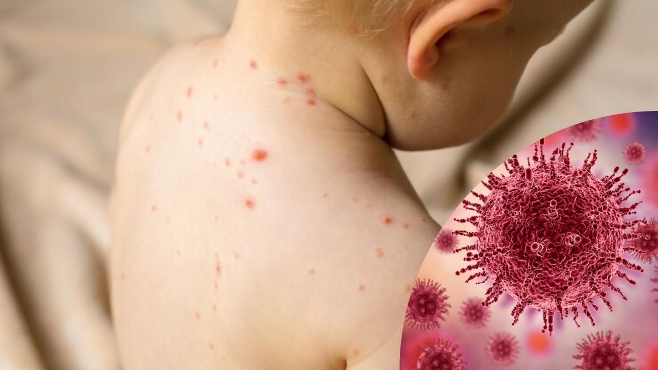SS reporta cuatro muertes por sarampión en lo que va de 2025