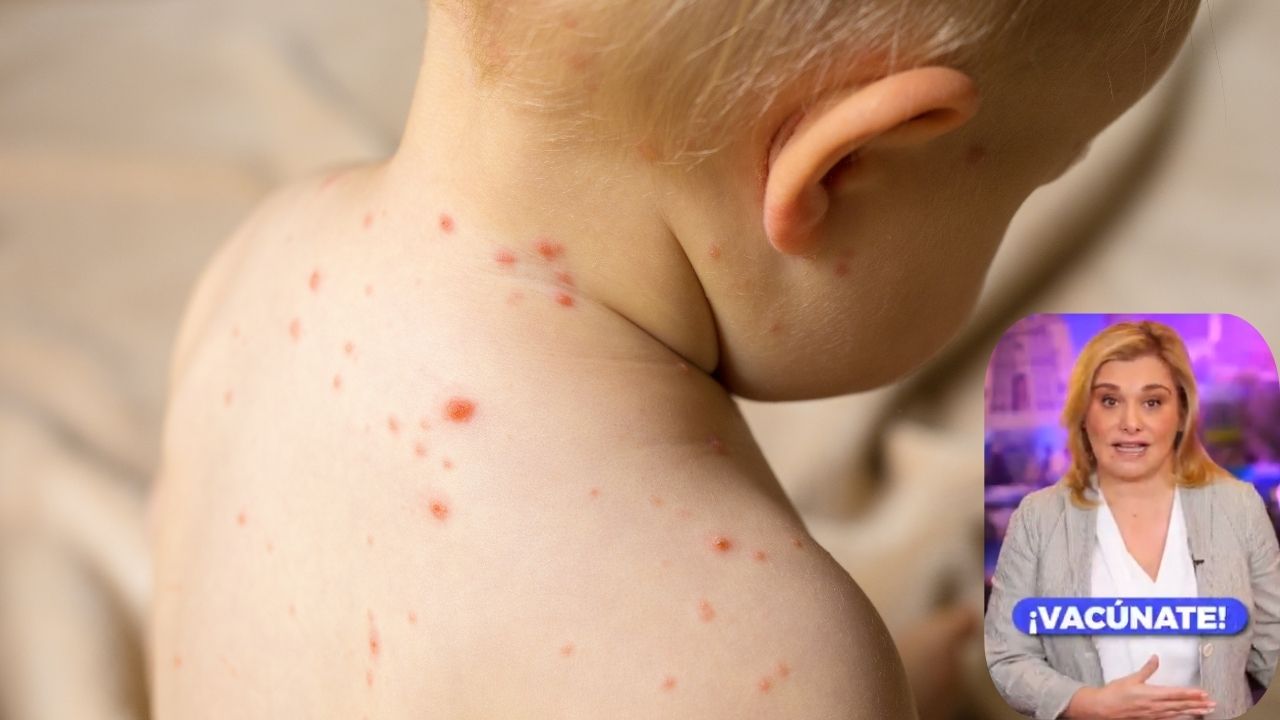 Chihuahua supera los 3,300 casos de sarampión