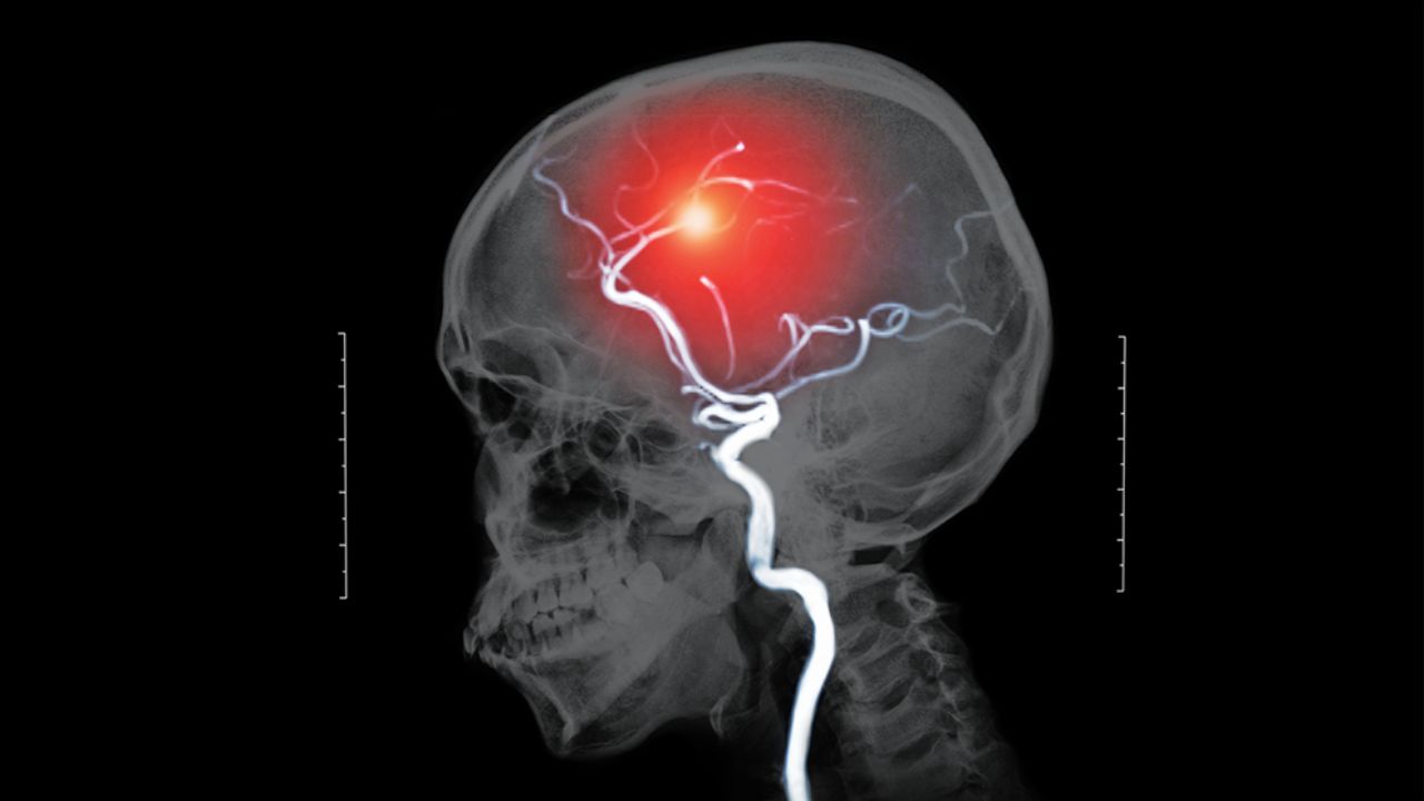 Aumentan infartos cerebrales en México
