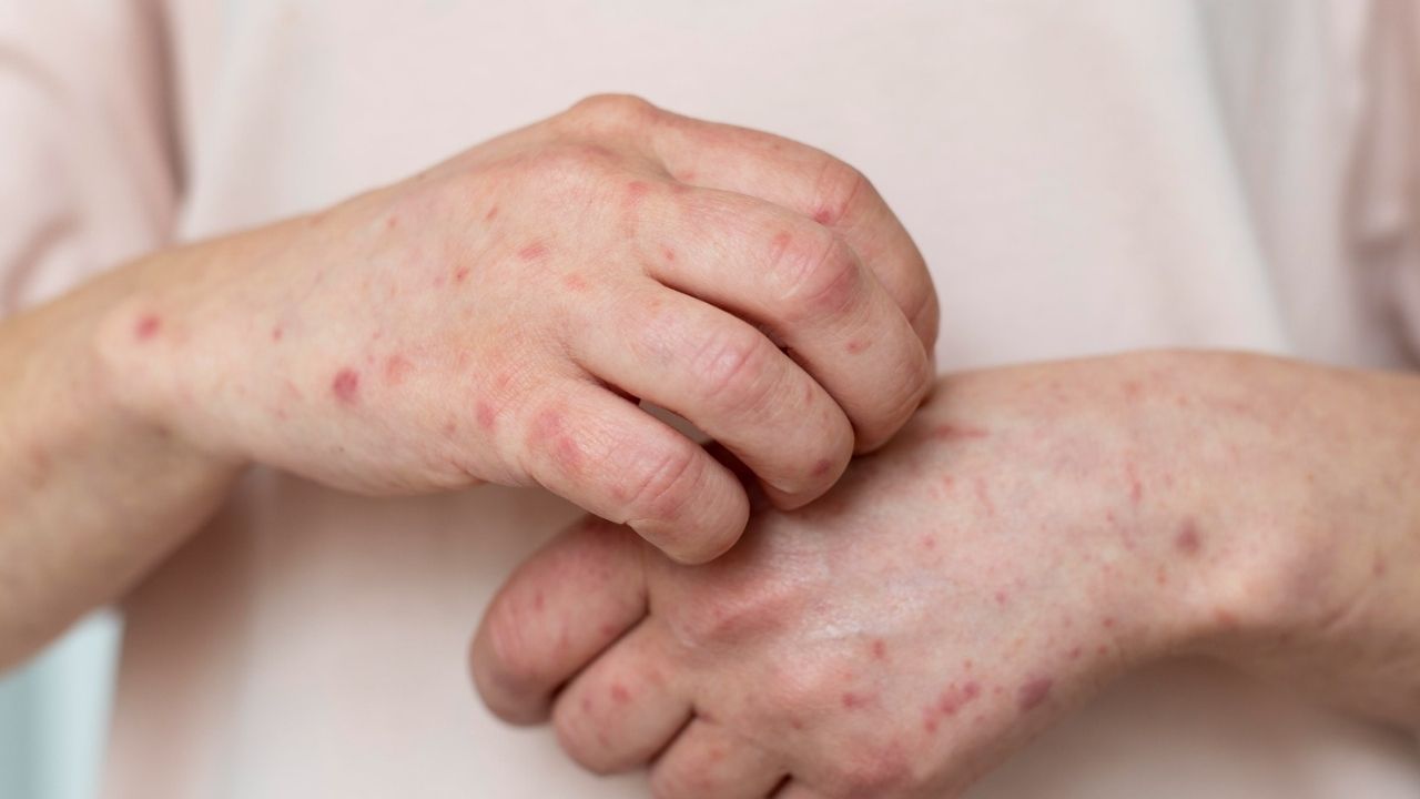 Hidalgo confirma décimo caso de sarampión