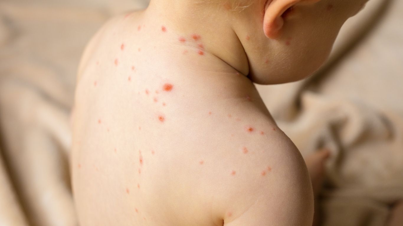 CDMX registra 576 casos de sarampión