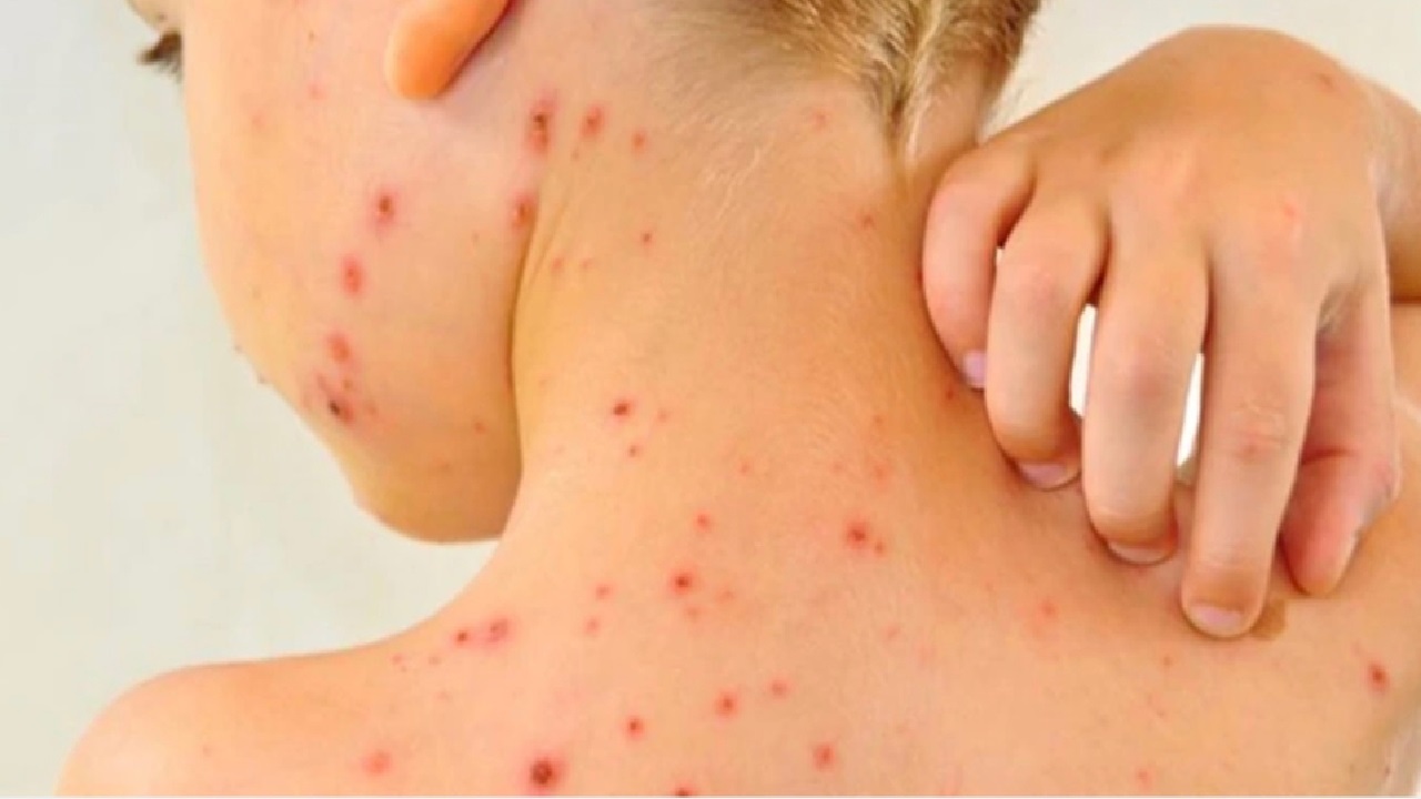 Suman 33 muertes por sarampión en el país: SSa