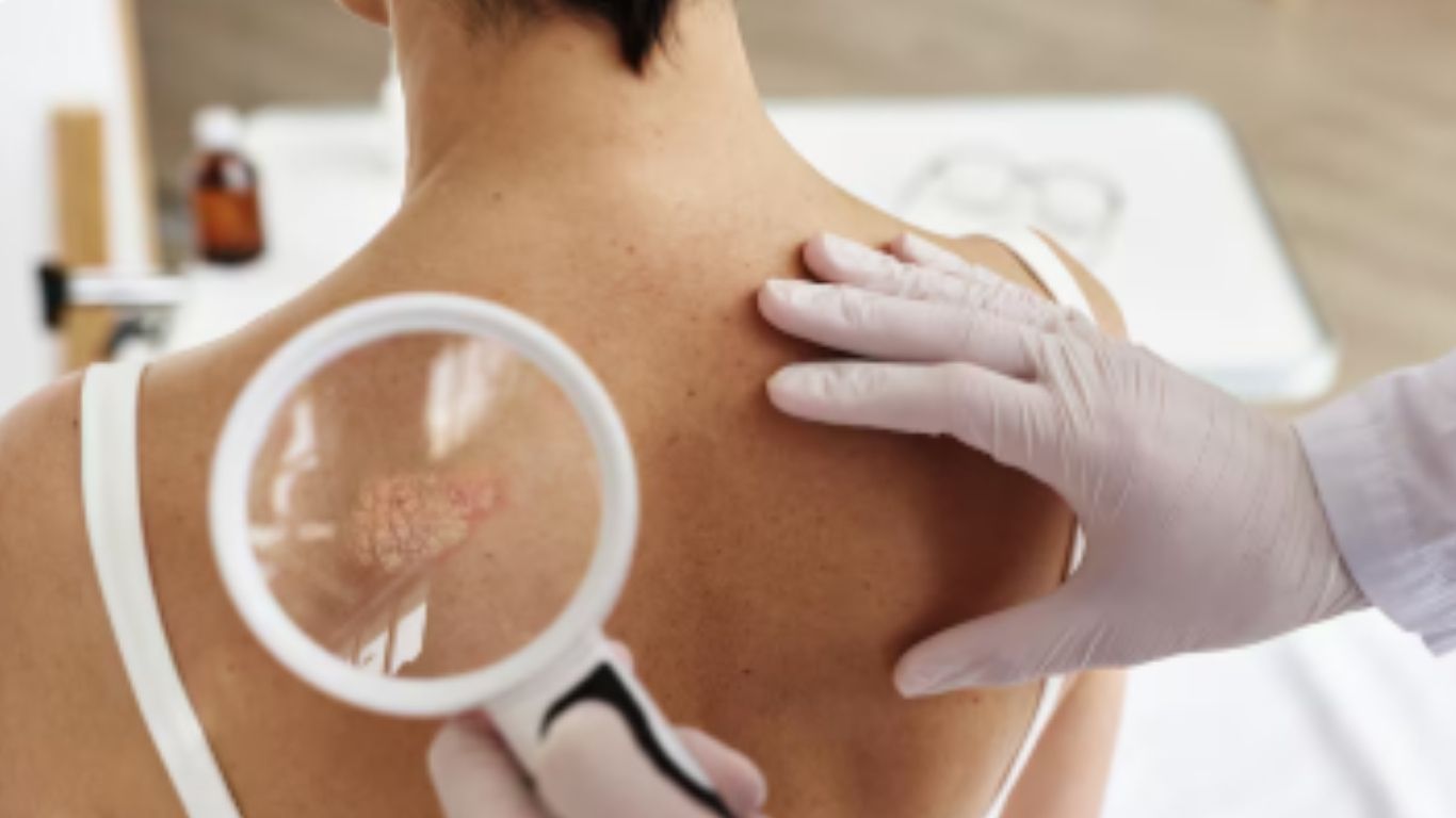 Ofrecen detección gratuita de cáncer de piel