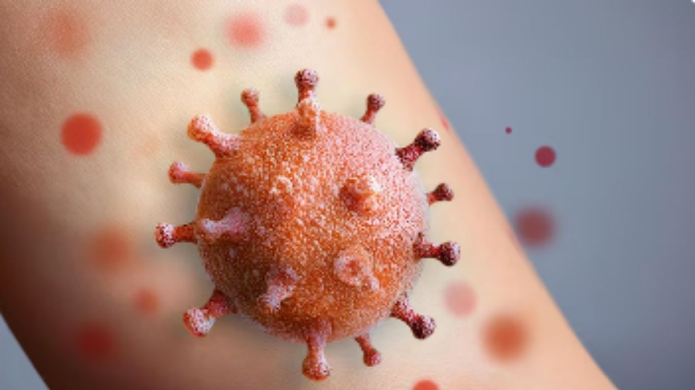 Perú emite alerta epidemiológica por sarampión